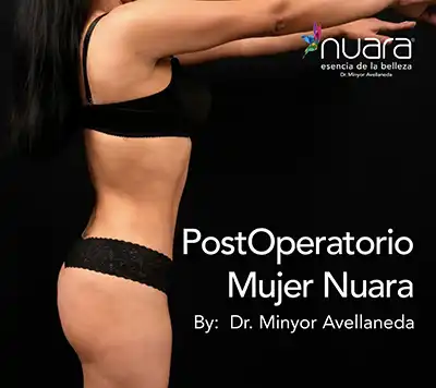Lipectomía PostOperatorio Dr Minyor Avellaneda Resultado postoperatorio de Lipectomía en Bogotá. Mujer realizado por el Dr. Minyor Avellaneda en Nuara.