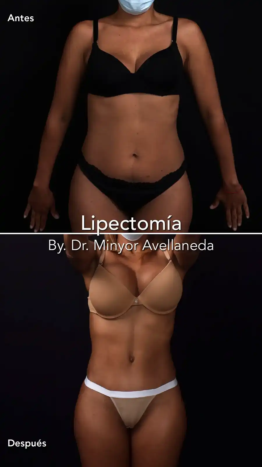 Lipectomía Abdominal Antes y Después Antes y después de Lipectomía en Bogotá: abdomen firme y cintura definida por el Dr. Minyor Avellaneda en Nuara.