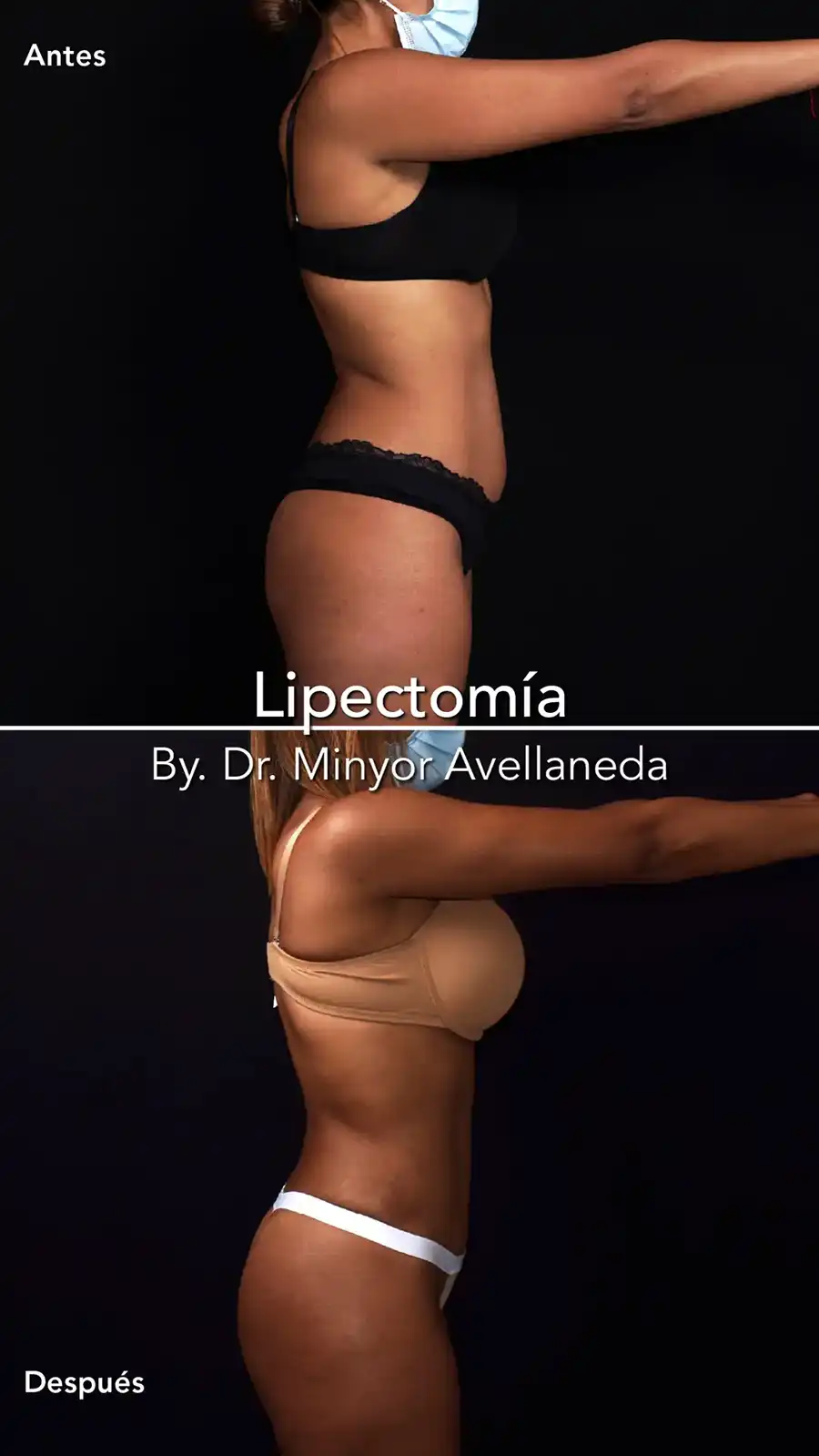 Lipectomía Bogotá Perfil Antes y Después Perfil de antes y después de Lipectomía en Bogotá: eliminación de flacidez y abdomen plano por el Dr. Minyor Avellaneda.