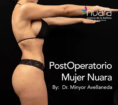 Postoperatorio Lipectomía Mujer Nuara Perfil Postoperatorio de Lipectomía en Bogotá. perfil abdominal definido de una paciente del Dr. Minyor Avellaneda en Nuara.
