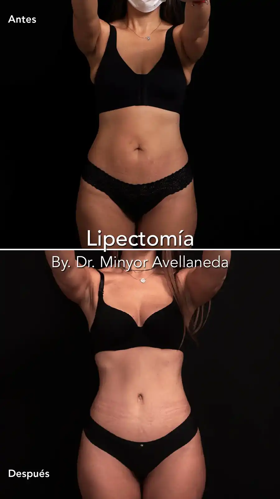 Lipectomía Bogotá Resultados Frontales Resultado de Lipectomía en Bogotá: antes y después frontal con abdomen firme y piel tensa por el Dr. Minyor Avellaneda.