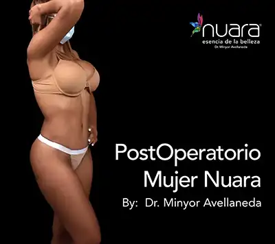 Lipectomía Postoperatorio Mujer Nuara Resultado de Lipectomía en Bogotá: contorno definido y abdomen firme por el Dr. Minyor Avellaneda en Nuara.