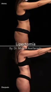 Lipectomía Bogotá Perfil Resultados Perfil de paciente antes y después de Lipectomía en Bogotá con el Dr. Minyor Avellaneda en Nuara.