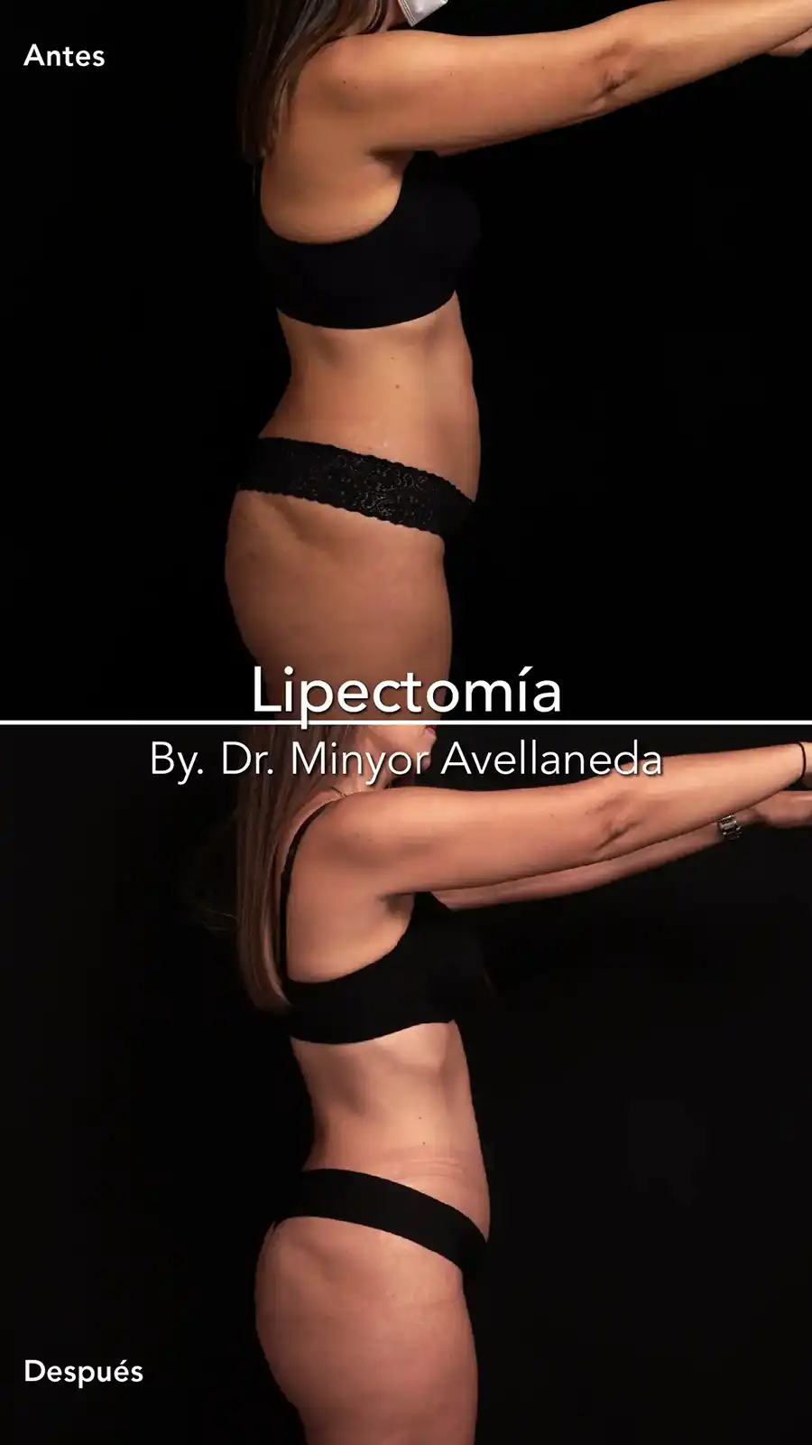 Lipectomía Bogotá Perfil Resultados Perfil de paciente antes y después de Lipectomía en Bogotá con el Dr. Minyor Avellaneda en Nuara.