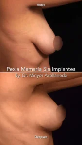 Pexia Mamaria Sin Implantes - Antes y Después Antes y después lateral de pexia mamaria sin implantes realizada por el Dr. Minyor Avellaneda en Bogotá, vista de perfil.