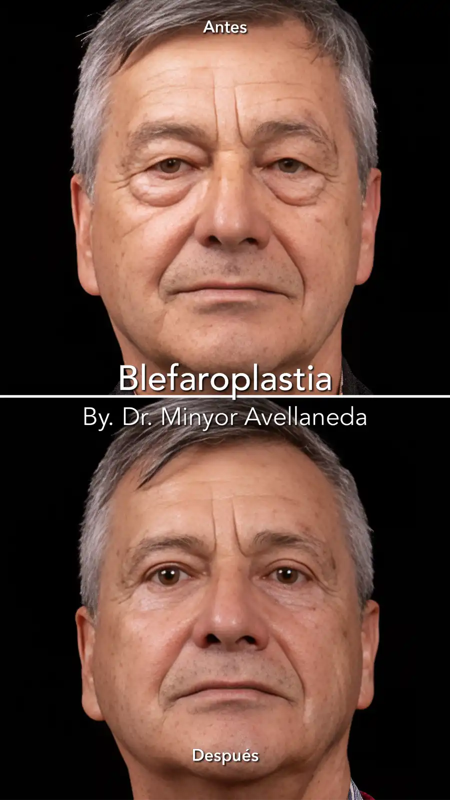 Blefaroplastia Antes y Después – Dr. Minyor Avellaneda Blefaroplastia antes y despues en hombre, mejora de parpados y mirada rejuvenecida.