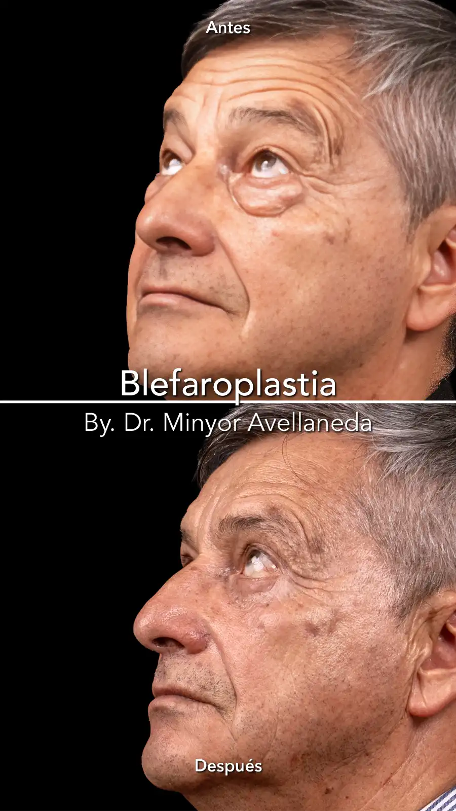 Blefaroplastia Perfil Antes y Después Blefaroplastia antes y despues en perfil de hombre con bolsas en parpados, mirada rejuvenecida