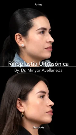 Rinoplastia Ultrasónica Femenina by Minyor Avellaneda Rinoplastia Ultrasónica Femenina en Bogotá. Antes y Después destacando la definición de la punta nasal por Dr. Minyor Avellaneda.