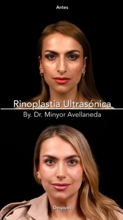 Rinoplastia Ultrasónica Femenina by Minyor Avellaneda Rinoplastia Ultrasónica Femenina en Bogotá. Antes y Después destacando la definición de la punta nasal por Dr. Minyor Avellaneda.