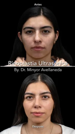 Rinoplastia Ultrasónica Femenina by Minyor Avellaneda Rinoplastia Ultrasónica Femenina en Bogotá. Antes y Después destacando la definición de la punta nasal por Dr. Minyor Avellaneda.