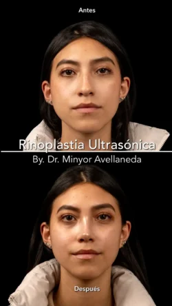Rinoplastia Ultrasónica Femenina by Minyor Avellaneda Rinoplastia Ultrasónica Femenina en Bogotá. Antes y Después destacando la definición de la punta nasal por Dr. Minyor Avellaneda.