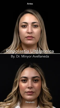 Rinoplastia Ultrasónica Femenina by Minyor Avellaneda Rinoplastia Ultrasónica Femenina en Bogotá. Antes y Después destacando la definición de la punta nasal por Dr. Minyor Avellaneda.
