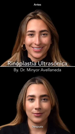 Rinoplastia Ultrasónica Femenina by Minyor Avellaneda Rinoplastia Ultrasónica Femenina en Bogotá. Antes y Después destacando la definición de la punta nasal por Dr. Minyor Avellaneda.