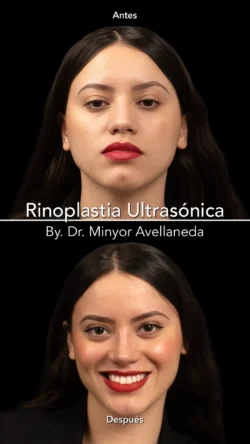 Rinoplastia Ultrasónica Femenina by Minyor Avellaneda Rinoplastia Ultrasónica Femenina en Bogotá. Antes y Después destacando la definición de la punta nasal por Dr. Minyor Avellaneda.