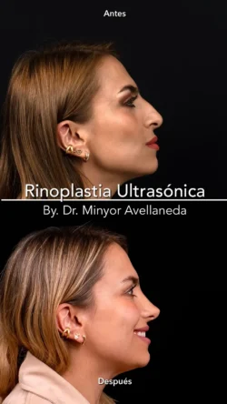 Rinoplastia Ultrasónica Femenina by Minyor Avellaneda Rinoplastia Ultrasónica Femenina en Bogotá. Antes y Después destacando la definición de la punta nasal por Dr. Minyor Avellaneda.