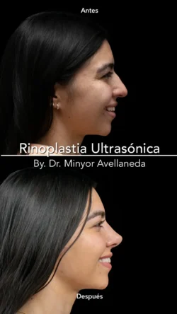 Rinoplastia Ultrasónica Femenina by Minyor Avellaneda Rinoplastia Ultrasónica Femenina en Bogotá. Antes y Después destacando la definición de la punta nasal por Dr. Minyor Avellaneda.