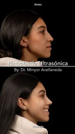 Rinoplastia Ultrasónica Femenina by Minyor Avellaneda Rinoplastia Ultrasónica Femenina en Bogotá. Antes y Después destacando la definición de la punta nasal por Dr. Minyor Avellaneda.