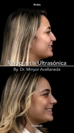 Rinoplastia Ultrasónica Femenina by Minyor Avellaneda Rinoplastia Ultrasónica Femenina en Bogotá. Antes y Después destacando la definición de la punta nasal por Dr. Minyor Avellaneda.