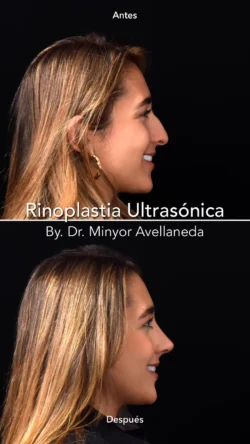 Rinoplastia Ultrasónica Femenina by Minyor Avellaneda Rinoplastia Ultrasónica Femenina en Bogotá. Antes y Después destacando la definición de la punta nasal por Dr. Minyor Avellaneda.