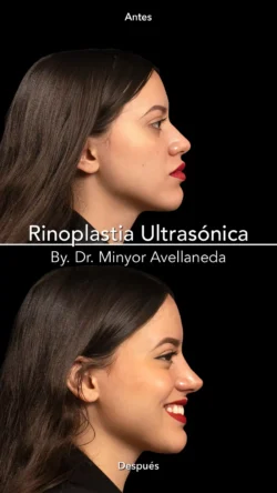 Rinoplastia Ultrasónica Femenina by Minyor Avellaneda Rinoplastia Ultrasónica Femenina en Bogotá. Antes y Después destacando la definición de la punta nasal por Dr. Minyor Avellaneda.