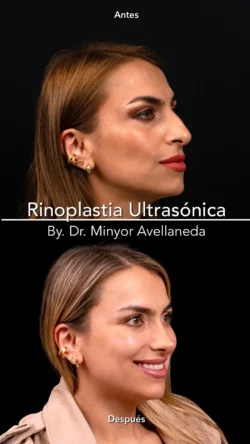 Rinoplastia Ultrasónica Femenina by Minyor Avellaneda Rinoplastia Ultrasónica Femenina en Bogotá. Antes y Después destacando la definición de la punta nasal por Dr. Minyor Avellaneda.