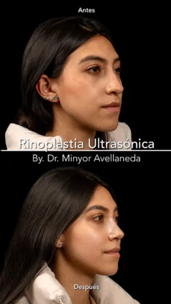 Rinoplastia Ultrasónica Femenina by Minyor Avellaneda Rinoplastia Ultrasónica Femenina en Bogotá. Antes y Después destacando la definición de la punta nasal por Dr. Minyor Avellaneda.