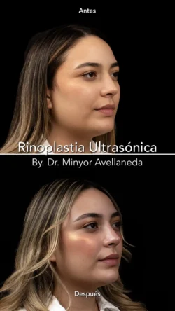 Rinoplastia Ultrasónica Femenina by Minyor Avellaneda Rinoplastia Ultrasónica Femenina en Bogotá. Antes y Después destacando la definición de la punta nasal por Dr. Minyor Avellaneda.