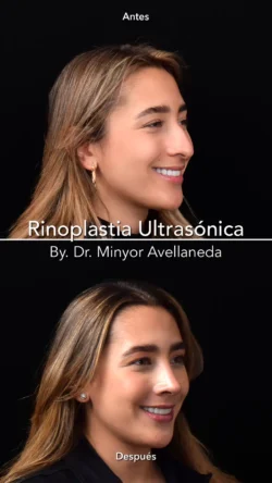 Rinoplastia Ultrasónica Femenina by Minyor Avellaneda Rinoplastia Ultrasónica Femenina en Bogotá. Antes y Después destacando la definición de la punta nasal por Dr. Minyor Avellaneda.