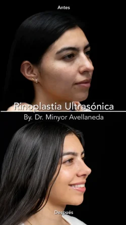 Rinoplastia Ultrasónica Femenina by Minyor Avellaneda Rinoplastia Ultrasónica Femenina en Bogotá. Antes y Después destacando la definición de la punta nasal por Dr. Minyor Avellaneda.