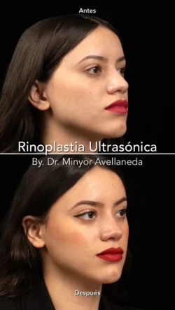 Rinoplastia Ultrasónica Femenina by Minyor Avellaneda Rinoplastia Ultrasónica Femenina en Bogotá. Antes y Después destacando la definición de la punta nasal por Dr. Minyor Avellaneda.