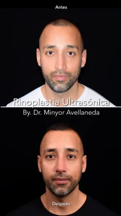 Rinoplastia Ultrasónica Masculina by Minyor Avellaneda resultado rinoplastia primaria antes despues masculino frontal bogota dr minyor avellaneda 1 Nuara Belleza
