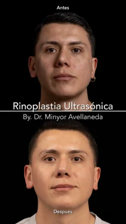 Rinoplastia Ultrasónica Masculina by Minyor Avellaneda resultado rinoplastia primaria antes despues masculino frontal bogota dr minyor avellaneda 2 Nuara Belleza