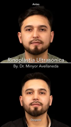 Rinoplastia Ultrasónica Masculina by Minyor Avellaneda resultado rinoplastia primaria antes despues masculino frontal bogota dr minyor avellaneda Nuara Belleza