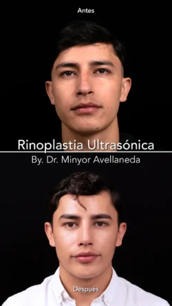 Rinoplastia Ultrasónica Masculina by Minyor Avellaneda resultado rinoplastia primaria antes despues masculino frontal bogota dr minyor avellaneda 3 Nuara Belleza