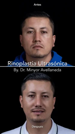 Rinoplastia Ultrasónica Masculina by Minyor Avellaneda resultado rinoplastia primaria antes despues masculino frontal bogota dr minyor avellaneda 4 Nuara Belleza