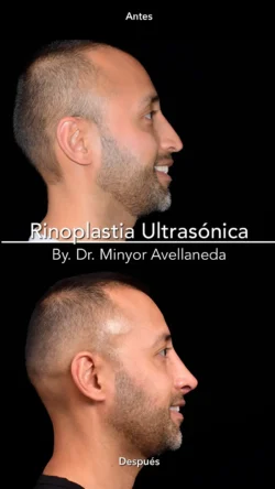 Rinoplastia Ultrasónica Masculina by Minyor Avellaneda resultado rinoplastia primaria antes despues masculino lateral bogota dr minyor avellaneda 1 Nuara Belleza