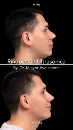 Rinoplastia Ultrasónica Masculina by Minyor Avellaneda resultado rinoplastia primaria antes despues masculino lateral bogota dr minyor avellaneda 2 Nuara Belleza