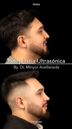 Rinoplastia Ultrasónica Masculina by Minyor Avellaneda resultado rinoplastia primaria antes despues masculino lateral bogota dr minyor avellaneda Nuara Belleza