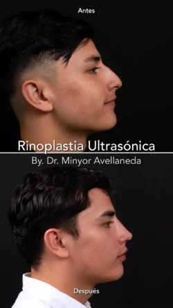 Rinoplastia Ultrasónica Masculina by Minyor Avellaneda resultado rinoplastia primaria antes despues masculino lateral bogota dr minyor avellaneda 3 Nuara Belleza