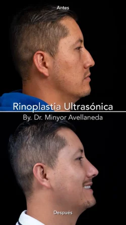 Rinoplastia Ultrasónica Masculina by Minyor Avellaneda resultado rinoplastia primaria antes despues masculino lateral bogota dr minyor avellaneda 4 Nuara Belleza