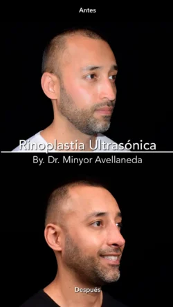 Rinoplastia Ultrasónica Masculina by Minyor Avellaneda resultado rinoplastia primaria antes despues masculino perfil bogota dr minyor avellaneda 1 Nuara Belleza