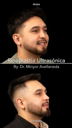 Rinoplastia Ultrasónica Masculina by Minyor Avellaneda resultado rinoplastia primaria antes despues masculino perfil bogota dr minyor avellaneda Nuara Belleza