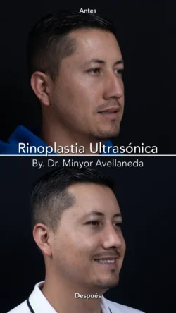 Rinoplastia Ultrasónica Masculina by Minyor Avellaneda resultado rinoplastia primaria antes despues masculino tres cuartos bogota dr minyor avellaneda 1 Nuara Belleza