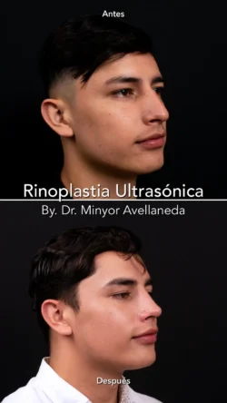 Rinoplastia Ultrasónica Masculina by Minyor Avellaneda resultado rinoplastia primaria antes despues masculino tres cuartos bogota dr minyor avellaneda Nuara Belleza