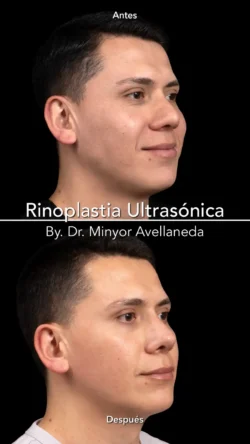Rinoplastia Ultrasónica Masculina by Minyor Avellaneda resultado rinoplastia primaria antes despues masculino tres cuertos bogota dr minyor avellaneda Nuara Belleza