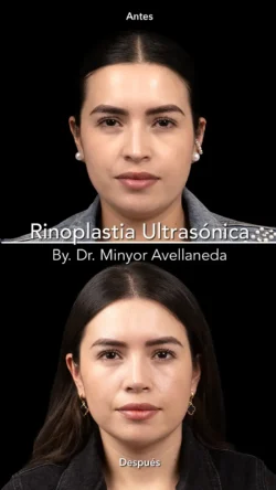 Rinoplastia Ultrasónica Femenina by Minyor Avellaneda Rinoplastia Ultrasónica Femenina en Bogotá. Antes y Después destacando la definición de la punta nasal por Dr. Minyor Avellaneda.