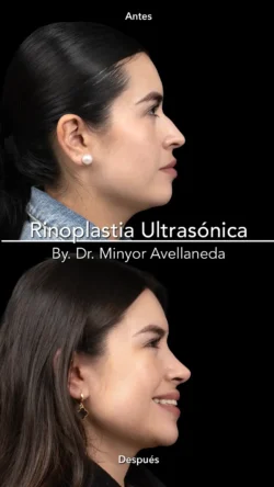 Rinoplastia Ultrasónica Femenina by Minyor Avellaneda Rinoplastia Ultrasónica Femenina en Bogotá. Antes y Después destacando la definición de la punta nasal por Dr. Minyor Avellaneda.