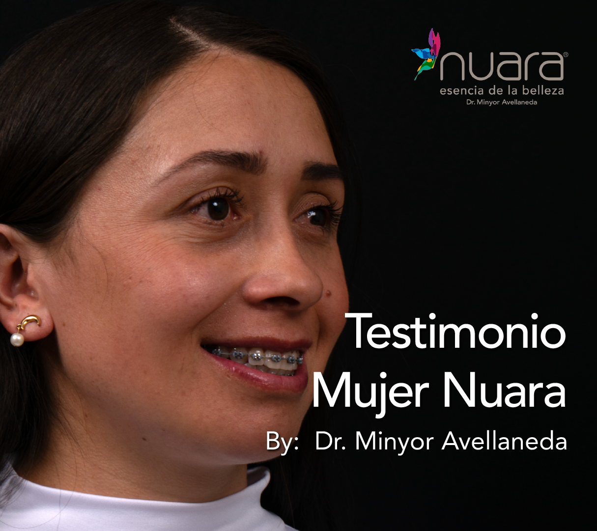Blefaroplastia By Minyor Avellaneda