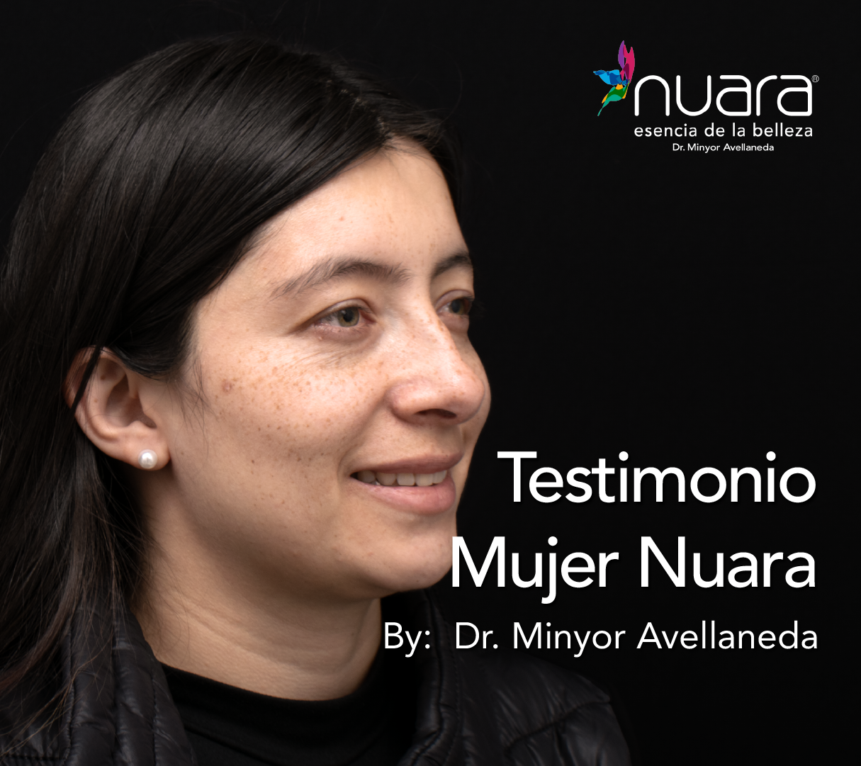 Blefaroplastia By Minyor Avellaneda