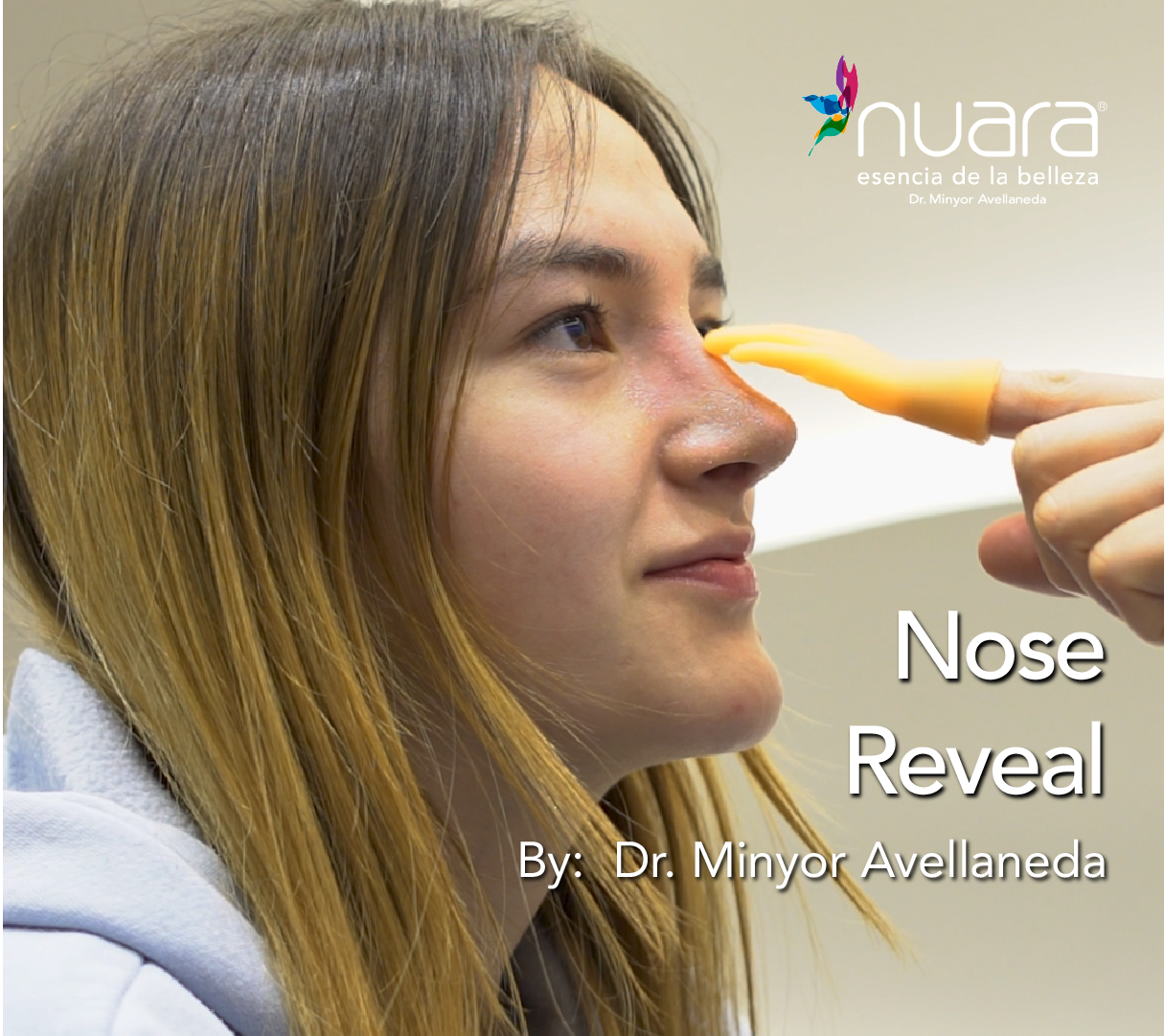 Rinoplastia Ultrasónica By Minyor Avellaneda